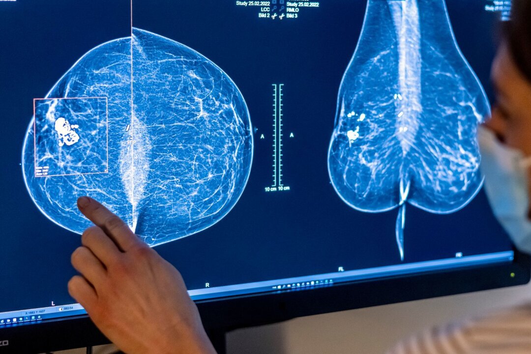 Einsatz von KI verändert Arbeitsweisen an Kliniken - Medizinisches Personal untersucht mit einer Mammografie die Brust einer Frau auf Brustkrebs.