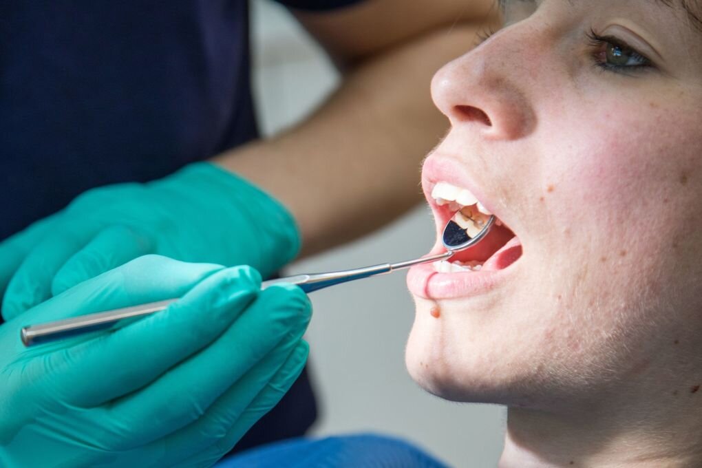 Bei Flecken im Mund den Zahnarzt aufsuchen - Veränderungen der Mundschleimhaut können Symptome einer solchen Erkrankung sein.