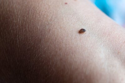 Nicht kratzen: Das hilft gegen Mücken und bei Mückenstichen - Bettwanzen ernähren sich von menschlichem Blut, sind aber harmlos.