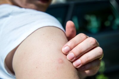 Nicht kratzen: Das hilft gegen Mücken und bei Mückenstichen - Mückenstiche sollte man nicht aufkratzen. Die Wunde könnte sich sonst entzünden.