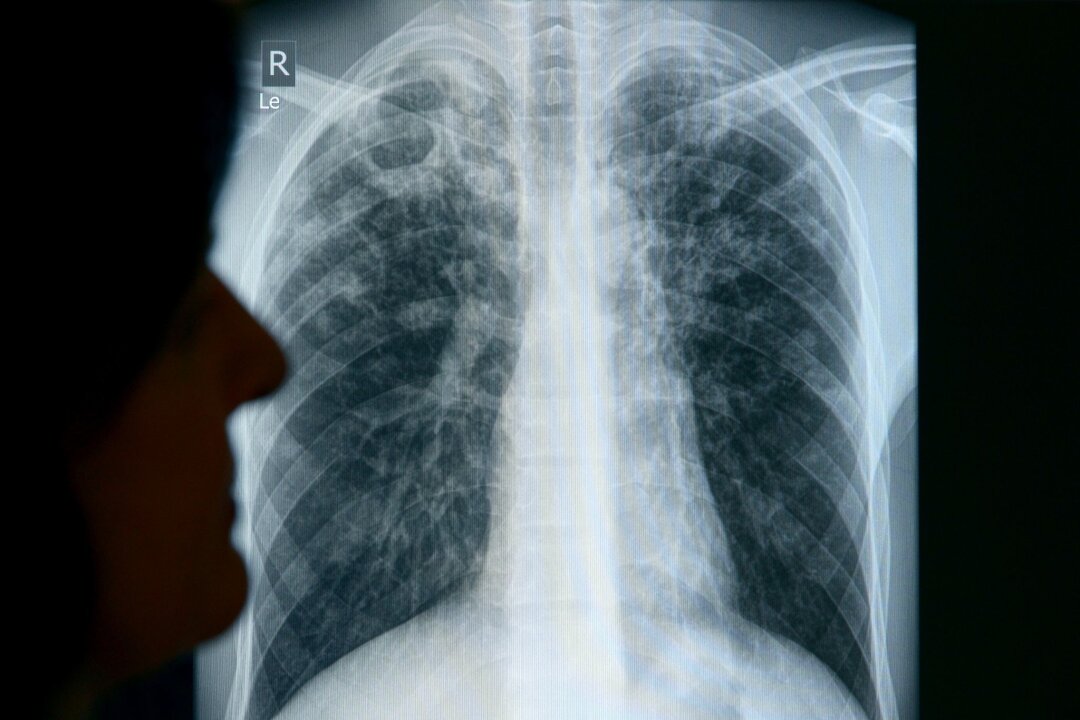 Tuberkulose-Erkrankungen in Sachsen konstant - Eine Ärztin wertet  die Röntgenaufnahme eines erkrankten Patienten aus.