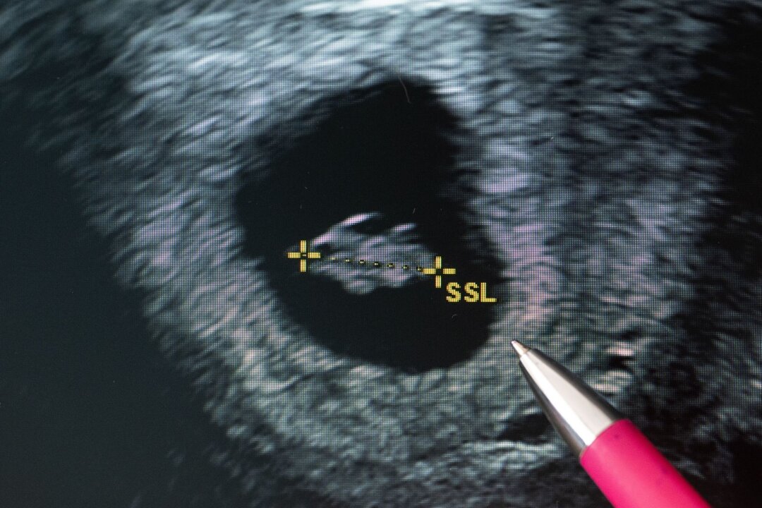 Zahl der Schwangerschaftsabbrüche leicht gestiegen - Eine Frauenärztin deutet auf den Fötus im Ultraschallbild.